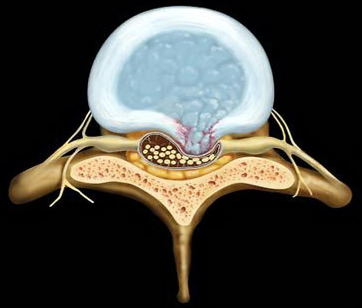 Chèn ép tủy sống - Hình ảnh minh họa